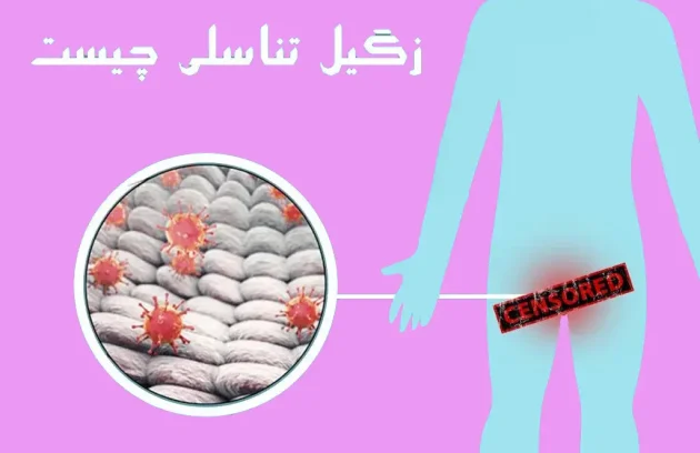 درمان زگیل تناسلی - درمان تضمینی