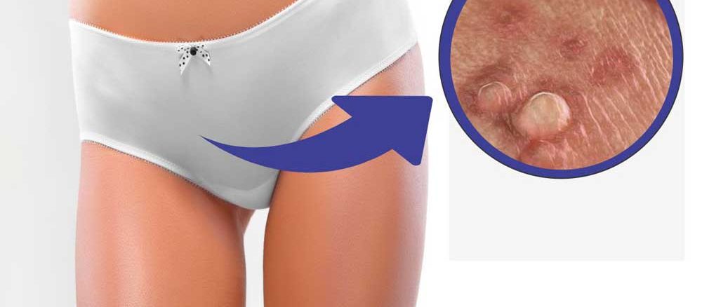 درمان زگیل تناسلی یا HPV