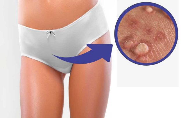 درمان زگیل تناسلی یا HPV