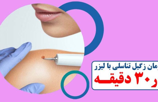 درمان زگیل تناسلی با لیزر