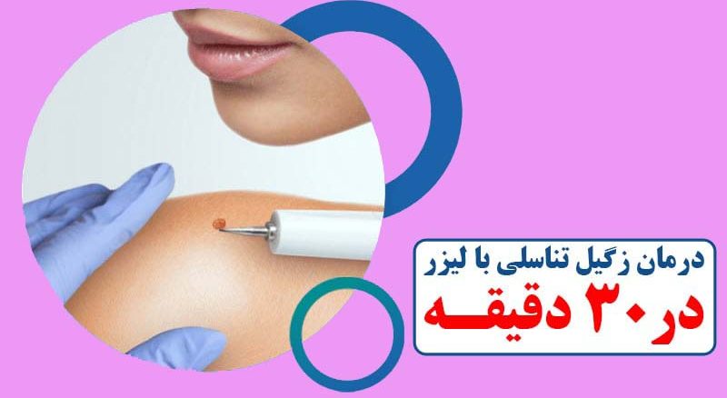 درمان زگیل تناسلی با لیزر
