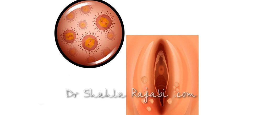 درمان اچ پی وی HPV زگیل تناسلی