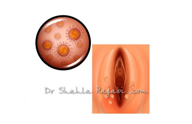 درمان اچ پی وی HPV زگیل تناسلی